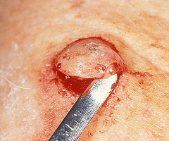 Кератоакантома кожи причина плоскоклеточного рака
